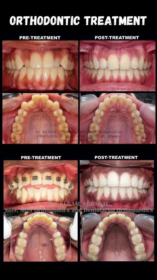 braces before and after bhopal 9